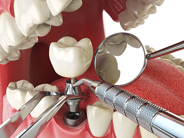 Emergency Dental Filling Replacement in MA